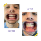 MNML Clear Aligners